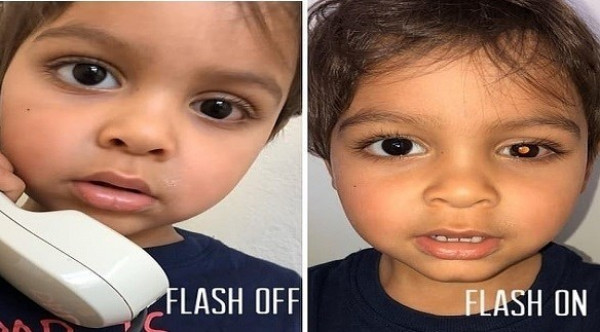 التقاط صورة لطفلك بفلاش الكاميرا قد ينقذه من سرطان نادر