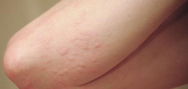 الطفح الجلدي قد يكون علامة رئيسية لإصابة (كورونا)
