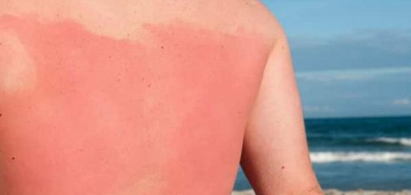 في موسم البحر والصيف.. كيف نعالج الجلد المتضرر من الشمس؟
