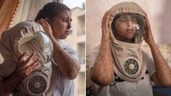 فتاة مغربية لم تتعرض لضوء النهار منذ 20 عامًا