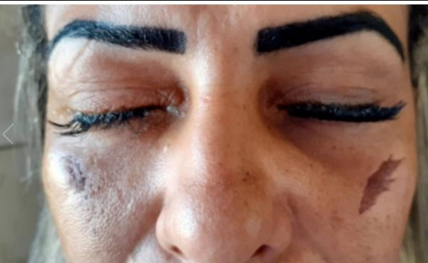 بسبب رموش صناعية.. سيدة تصاب بالعمى