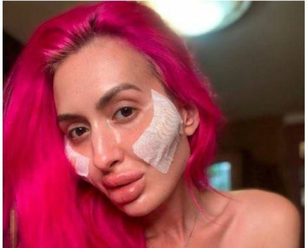 تعرّفوا على صاحبة الوجنتين الأكبر في العالم والمدمنة على عمليات التجميل