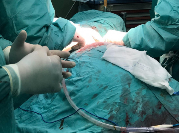 غزة: مجمع ناصر الطبي ينقذ حياة شاب ثلاثيني