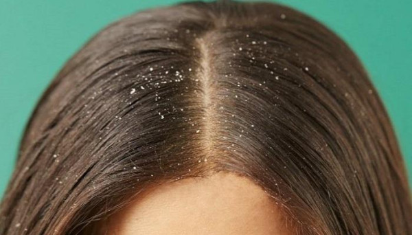 احذري من هذه الحيلة للتخلص من قشرة الشعر.. قد تسبب لك جراح وآلام خطيرة
