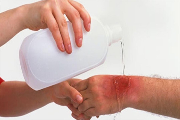 احذر.. هذه في علاج الحروق قد تزيد من الخطر