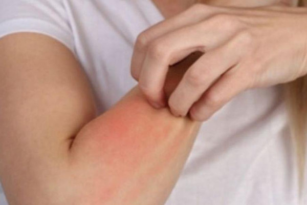 ما هي أكثر الأشياء التي تصيبك بالحساسية؟